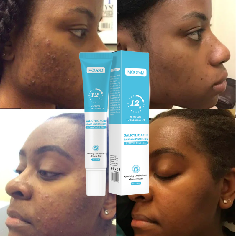 Gel Anti-Acné MOÔYAM ✨ Acide Salicylique | Élimine les boutons | Apaise & réduit les rougeurs (12H)
