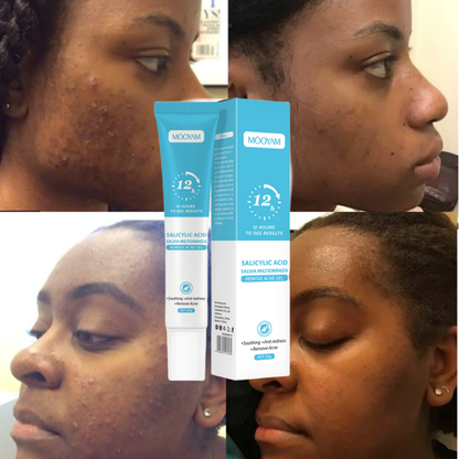 Gel Anti-Acné MOÔYAM ✨ Acide Salicylique | Élimine les boutons | Apaise & réduit les rougeurs (12H)