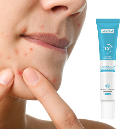 Gel Anti-Acné MOÔYAM ✨ Acide Salicylique | Élimine les boutons | Apaise & réduit les rougeurs (12H)