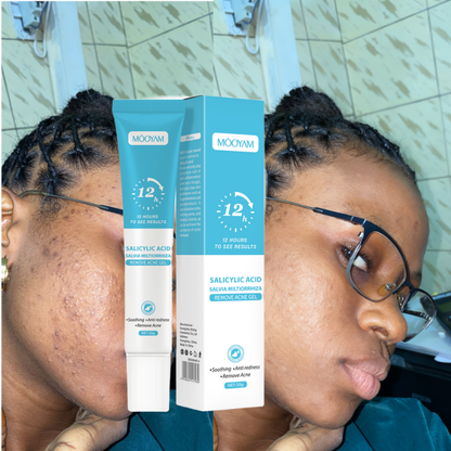 Gel Anti-Acné MOÔYAM ✨ Acide Salicylique | Élimine les boutons | Apaise & réduit les rougeurs (12H)