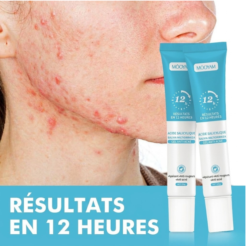 Gel Anti-Acné MOÔYAM ✨ Acide Salicylique | Élimine les boutons | Apaise & réduit les rougeurs (12H)